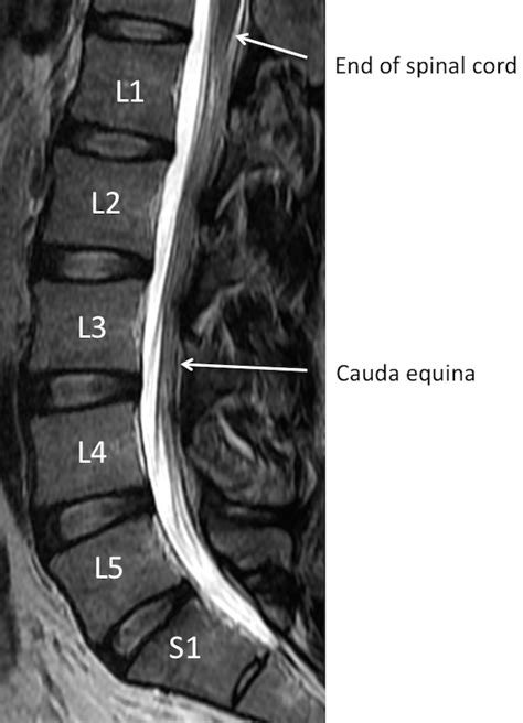 MRI Lumbar Spine Anatomy - Rocky Mountain Brain and Spine Institute