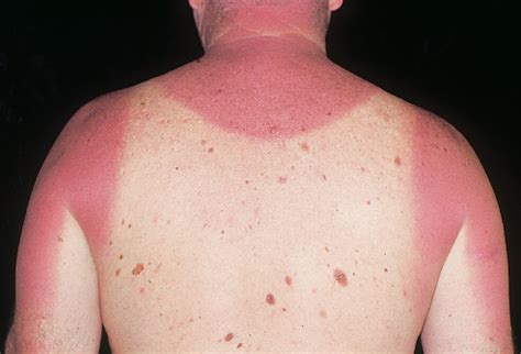 How to Avoid Sunburn and How to Treat a Sunburn