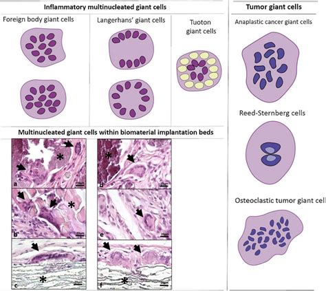 TB = Tuberculosis (*Histology of Mycobacterium Tuberculosis classic long…