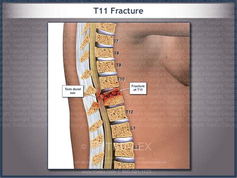 T11 Fracture - TrialQuest Inc.