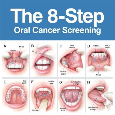 Tonsil Cancer Hpv