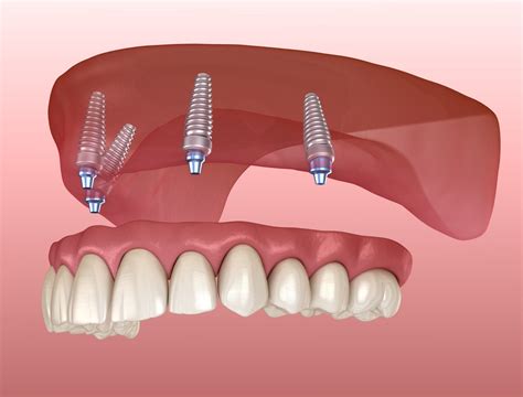 Dental Implants & Implant Fixed Dentures - Tulsa Precision Dental