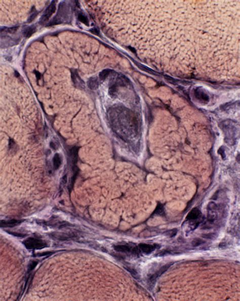 Trichinosis - Acute