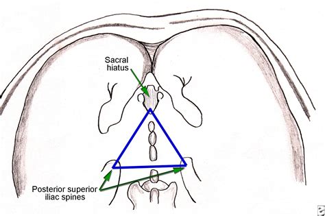 Anesthesia, Caudal; Anesthesia, Sacral Epidural