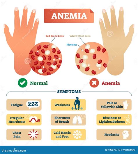 Anemia Cartoons, Illustrations & Vector Stock Images - 6009 Pictures to ...