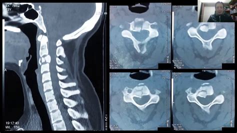 Caso Clínico ASPECIVE 21/01/2021 Corpectomía cervical - YouTube