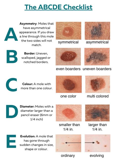 Melanoma Mole Vs Normal Mole