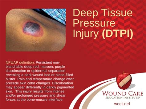 Test Your Pressure Injury Staging Skills - Updated for 2016