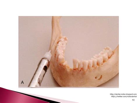 Dental Notes: Long Buccal Nerve Block NOTES