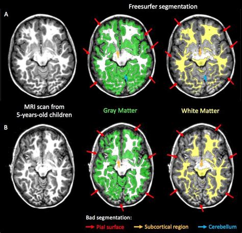 Gray matter and white matter segmentation obtained using Freesurfer... | Download Scientific Diagram