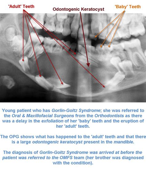 Odontogenic Keratocyst Radiology