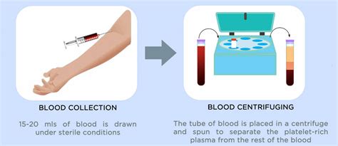 PRP injections – The Tendon Pain Clinic