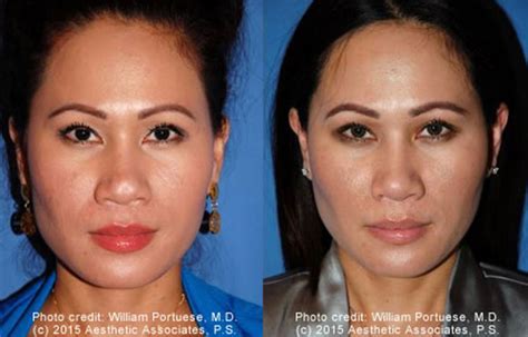 Have a Flat Nose? Rhinoplasty Can Fix That