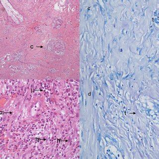 Histopathology revealed a caseation necrosis (c) surrounding by ...