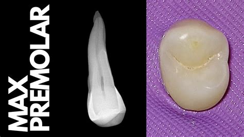 Maxillary Premolar {Access, Shape, Obturate} | All Things Endo