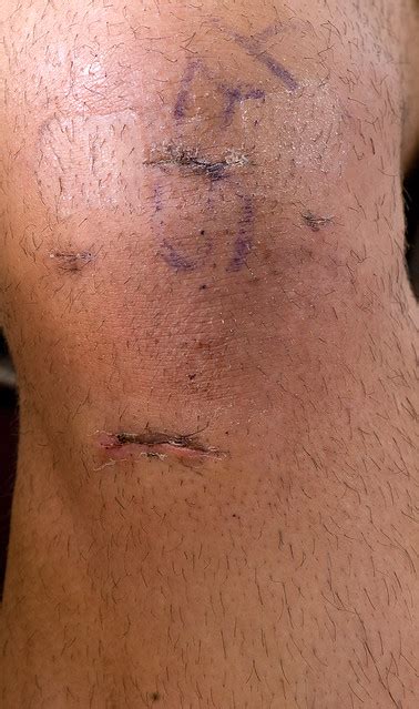 Knee surgery - scar +13 days | ACL [Anterior Cruciate Ligame… | Flickr