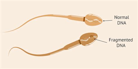 Sperm DNA Fragmentation and Male Infertility - Androlife