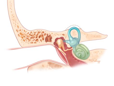 Superior Semicircular Canal Dehiscence – Oto Surgery Atlas