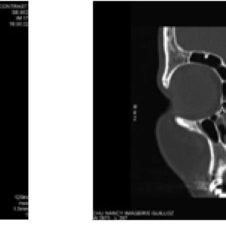 Normal Sinus CT-scan showing measurement method, in the axial and ...