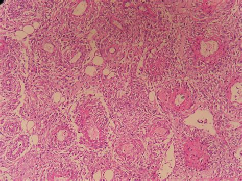 Kidney – Angiomyolipoma – Histopathology.guru