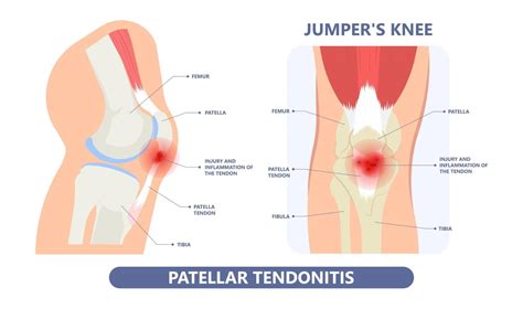 Patellar Tendon Tear: Symptoms, Causes, And Treatment | atelier-yuwa.ciao.jp