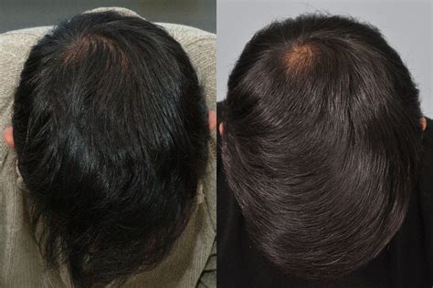 Minoxidil (Regaine) & FDA Medicine results after 10 years