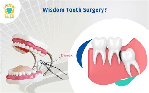 Is wisdom tooth removal a major surgery? | Elite Dental Care