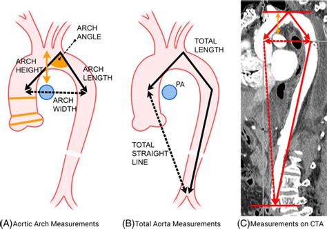 Aortic arch tortuosity, a novel biomarker for thoracic aortic disease ...