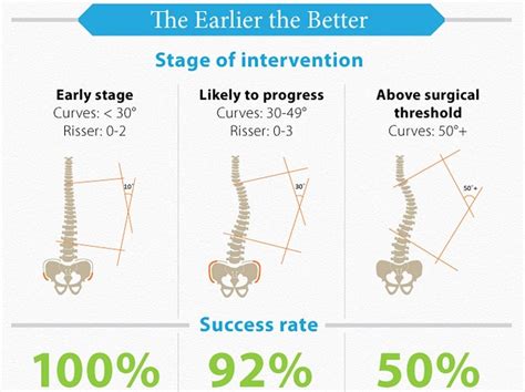 15 Degree Scoliosis: What Treatment is Required?