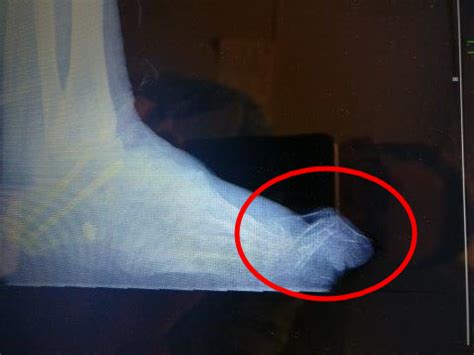 Swollen Middle Toe Joint [ Causes, Symptoms & Best Home Treatment]