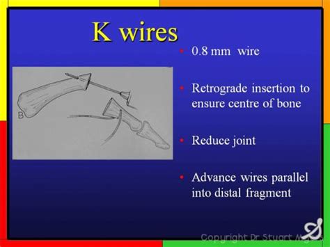 Tension Band Wiring