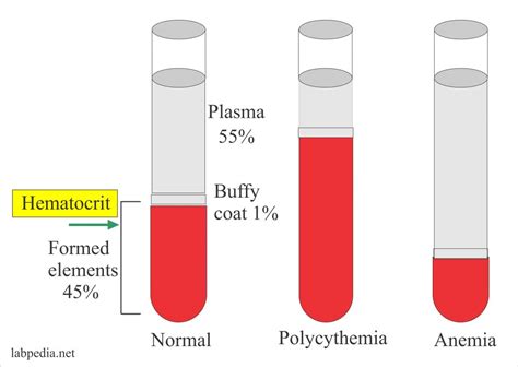 Anemia Hematocrit Levels