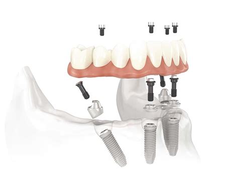 Full Arch Permanent Implants | Dental Implants Denver