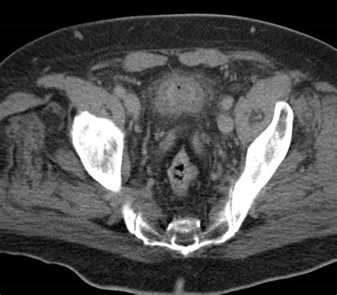 Acute Cystitis - Genitourinary Case Studies - CTisus CT Scanning