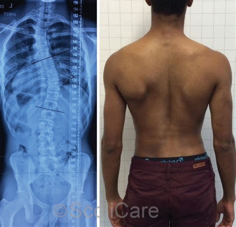 Reduction of a severe scoliosis using a ScoliBrace and scoliosis specific rehabilitation in a 14 ...