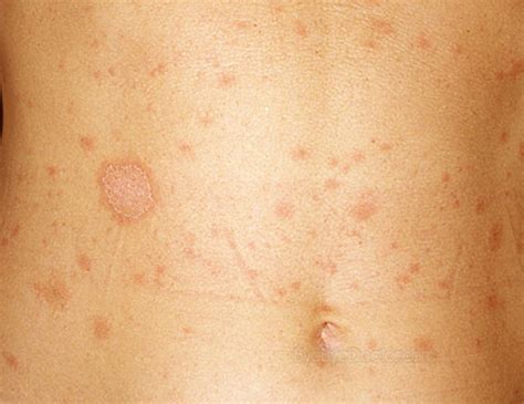 Pityriasis Rosea - Pictures, Treatment, Causes, Contagious, Symptoms ...