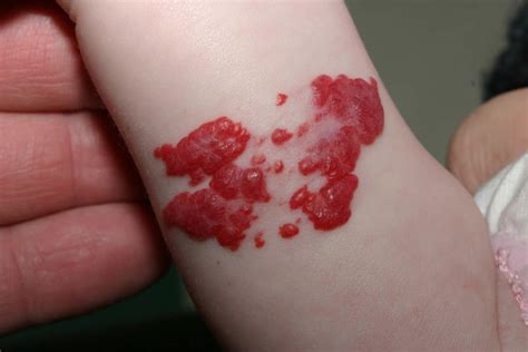 Birthmark causes, types of birthmarks and how to get rid of birthmarks