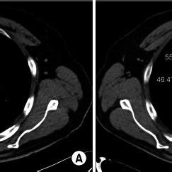 (A) Chest X-ray showed a large mass in the right paratracheal area ...