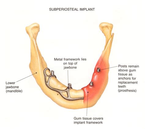 Subperiosteal Implant | Download Scientific Diagram