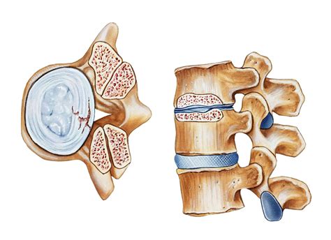 Lateral Recess Stenosis: Anatomy, Symptoms, Treatment