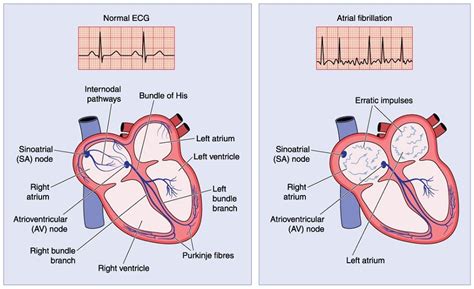 Atrial Fibrillation: The Basics - Cardiocare