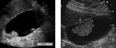 Strawberry Gallbladder Cholesterolosis Ultrasound - A Pictures Of Hole 2018