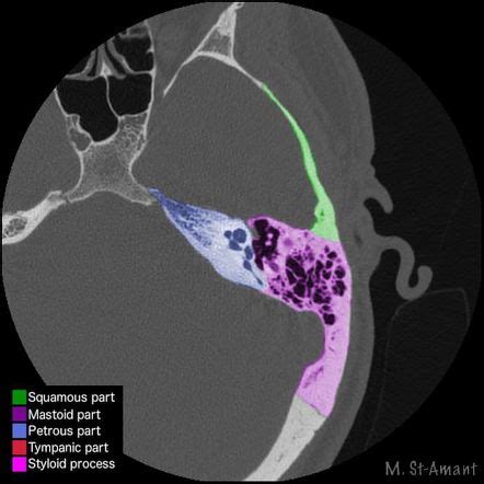 Petrous Part Of Temporal Bone - cloudshareinfo