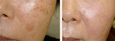 Syawa Nigma: Age Spot Removal Before After Photos