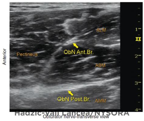 Ultrasound-Guided Obturator Nerve Block - NYSORA The New York School of ...