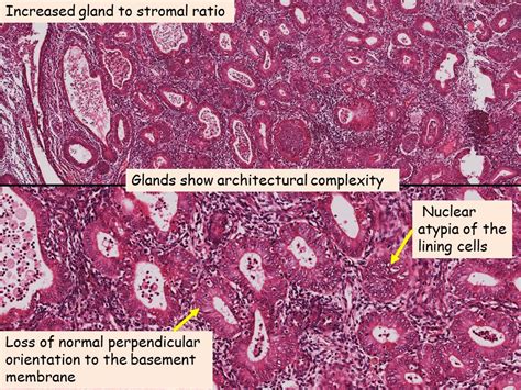 Pathology of Endometrial Hyperplasia - Pathology Made Simple