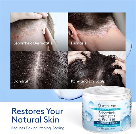 Buy Roycederm Seborrheic Dermatitis Cream, Psoriasis Cream, Scalp Treatment for Psoriasis ...