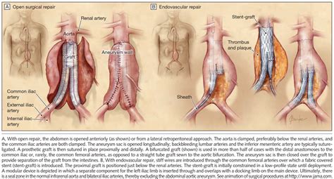 A 66-Year-Old Man With an Abdominal Aortic Aneurysm: Review of Screening and Treatment ...