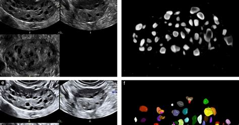 Ob/Gyn Updated : A practical guide to count ovarian antral follicles by ultrasound