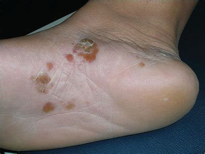 Itchy blisters on feet | MDedge Family Medicine